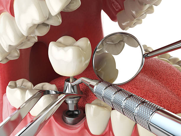 Best Emergency Dental Extractions in Utica, SC